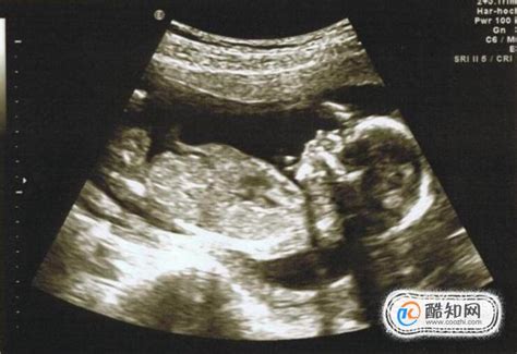 孕15周B超看胎儿性别
