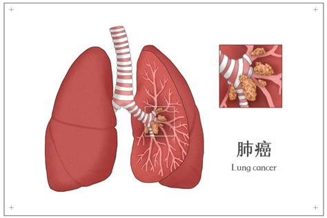 肺癌2期A是什么意思