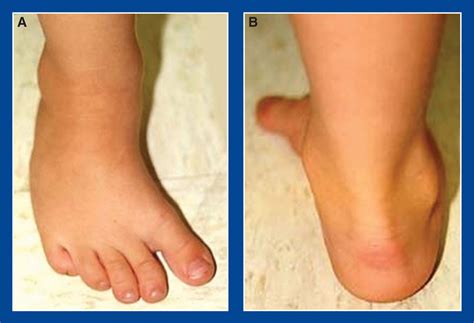 4 year old child with ankle valgus图片
