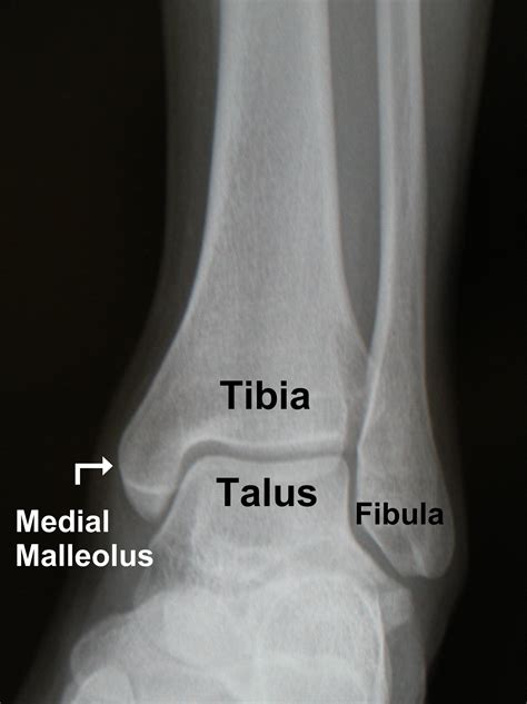 Ankle fibula fissure图片