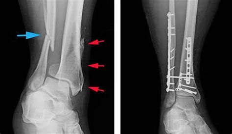 Ankle fracture upper plate图片