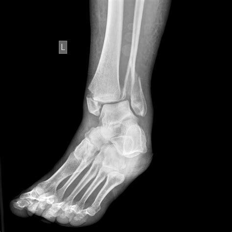 Ankle fracture website图片