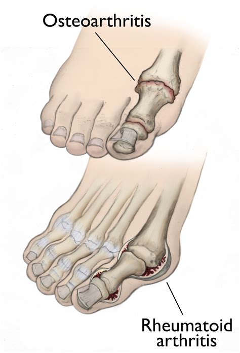 Big toe rheumatoid arthritis图片