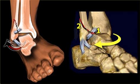 How long can an ankle avulsion fracture be able to walk?图片