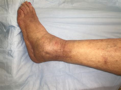 Infection after ankle fracture图片