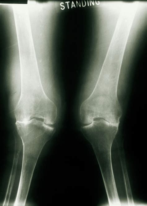 Knee rheumatoid arthritis图片