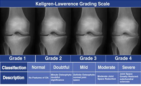 Stages of knee osteoarthritis图片