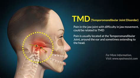 Temporomandibular Arthritis图片