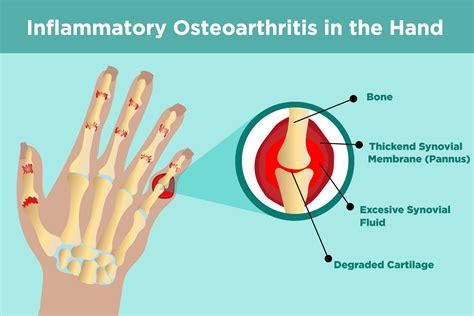 The main features of osteoarthritis pain图片