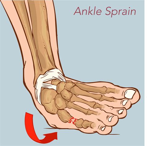 What to do with an ankle sprain图片