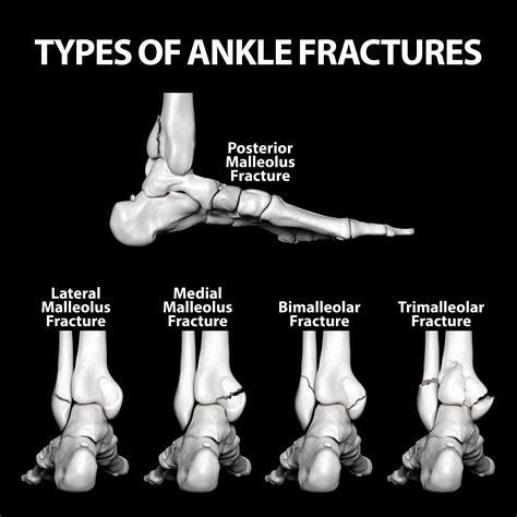 Will there be sequelae of comminuted ankle fracture?图片