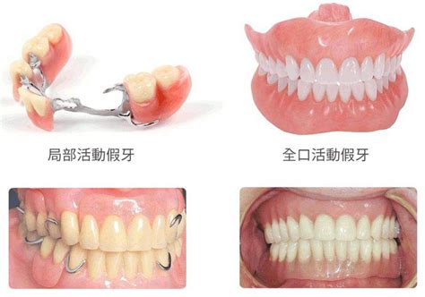固定义齿和种牙