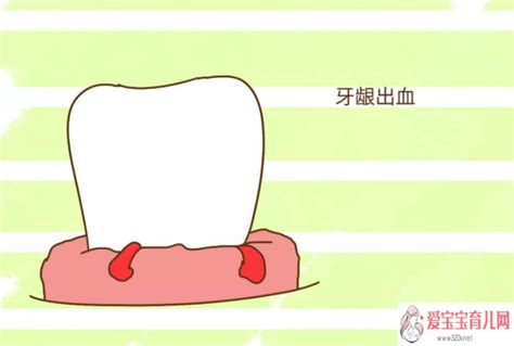 孕24周牙龈容易出血