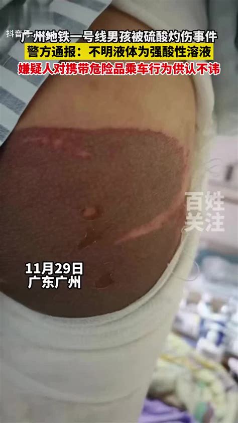 广州警方通报男孩地铁里被硫酸灼伤