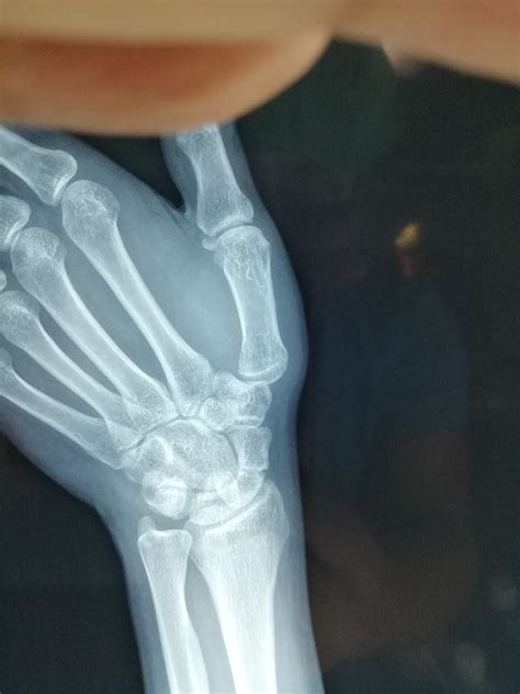 手腕骨折一般几个月恢复正常运转