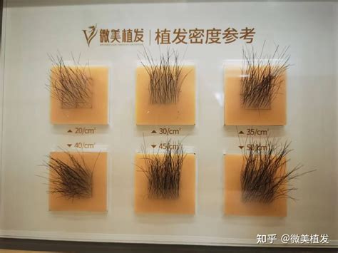 毛发种植一般每单位多少钱