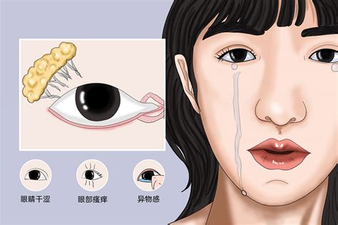 眼睛流泪是什么原因引起的流