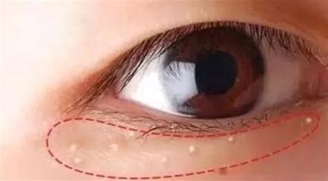 眼部周围容易长脂肪粒是什么原因