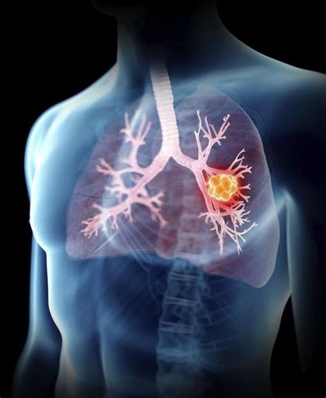 肺癌全球第一癌症