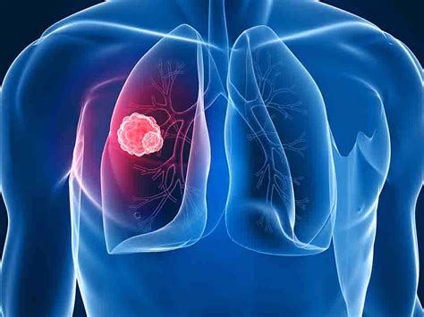 肺癌最难治的癌症